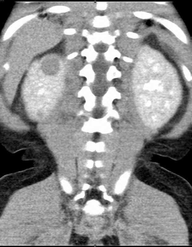 Dvě ložiska nefroblastomu v pravé ledvině (označena šipkou) u 17měsíční dívky s Beckwithovým-Wiedemannovým syndromem při CT zobrazení