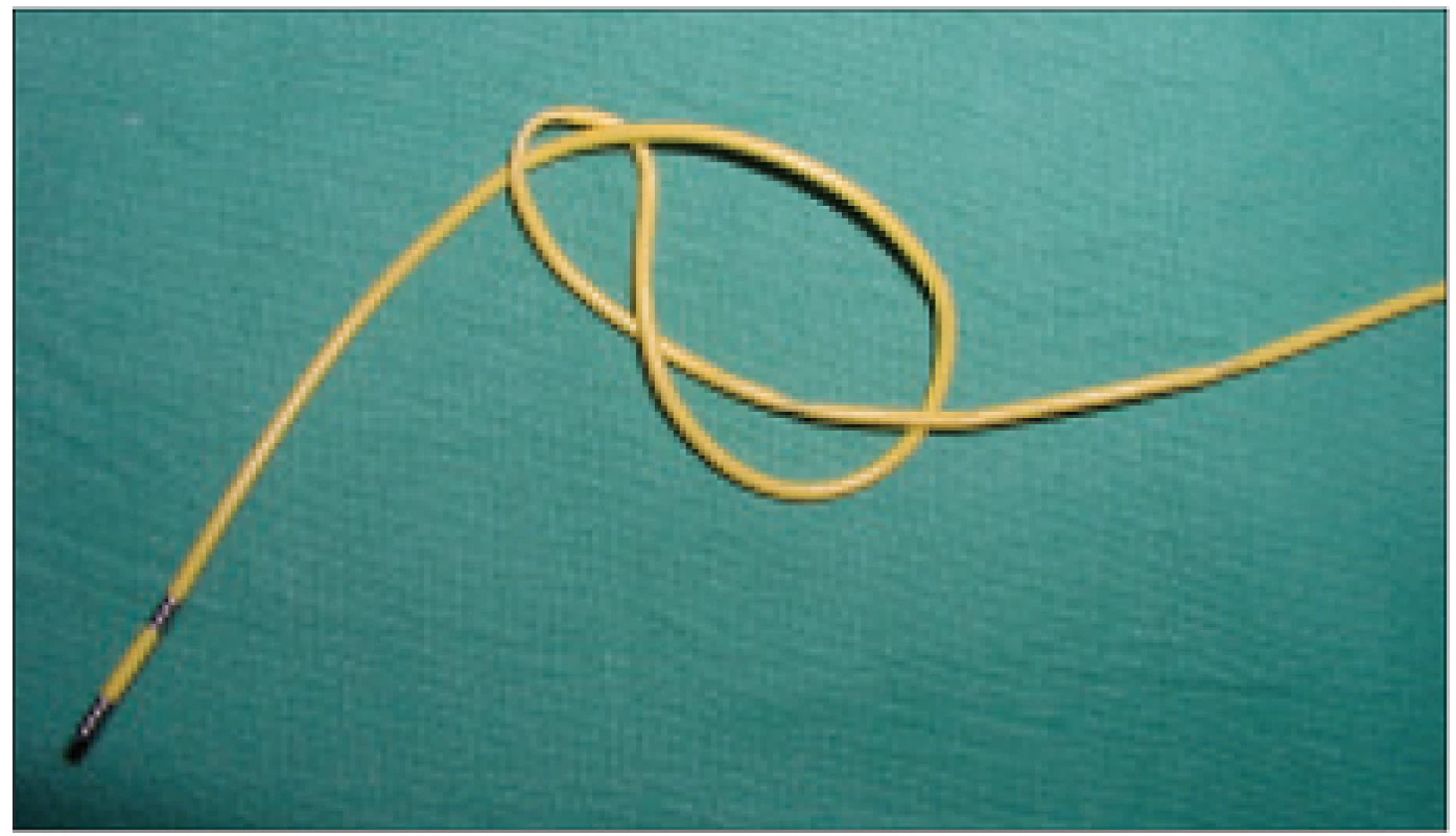 Dvojité zauzlení distální části kardiostimulační elektrody po extrakci na kardiochirugickém operačním sále.