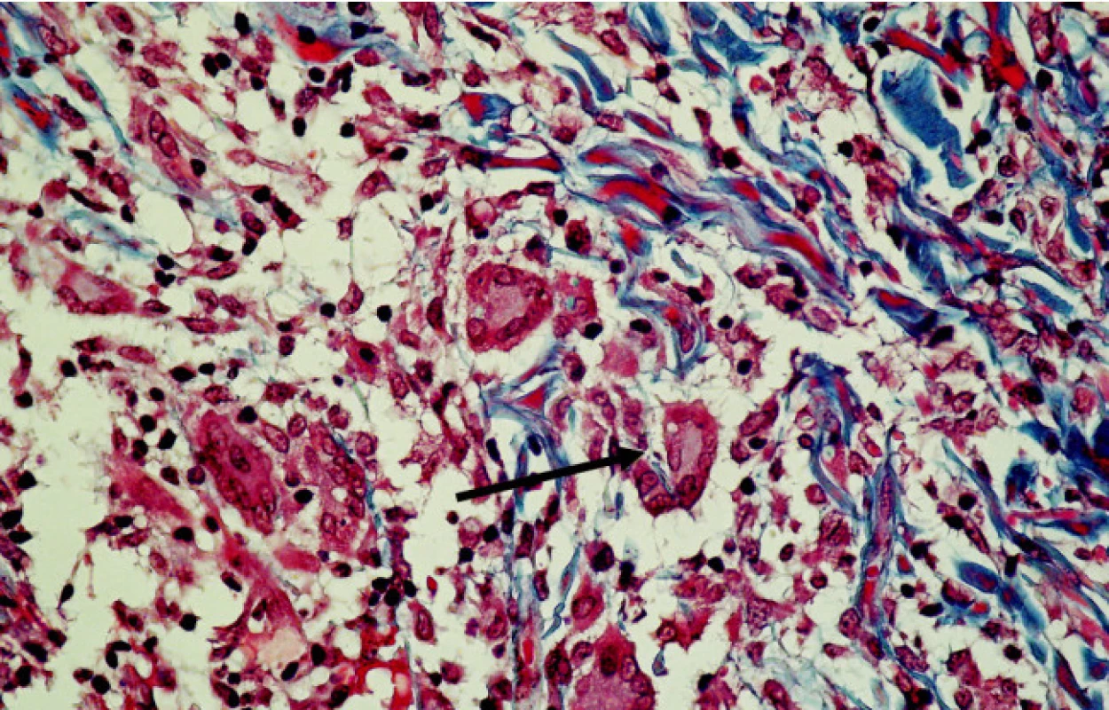 Obrovskobunkový zápalový infiltrát s fagocytózou deštruovaných kolagénových vláken /šípka/ (Massonov trichróm, 240-krát)