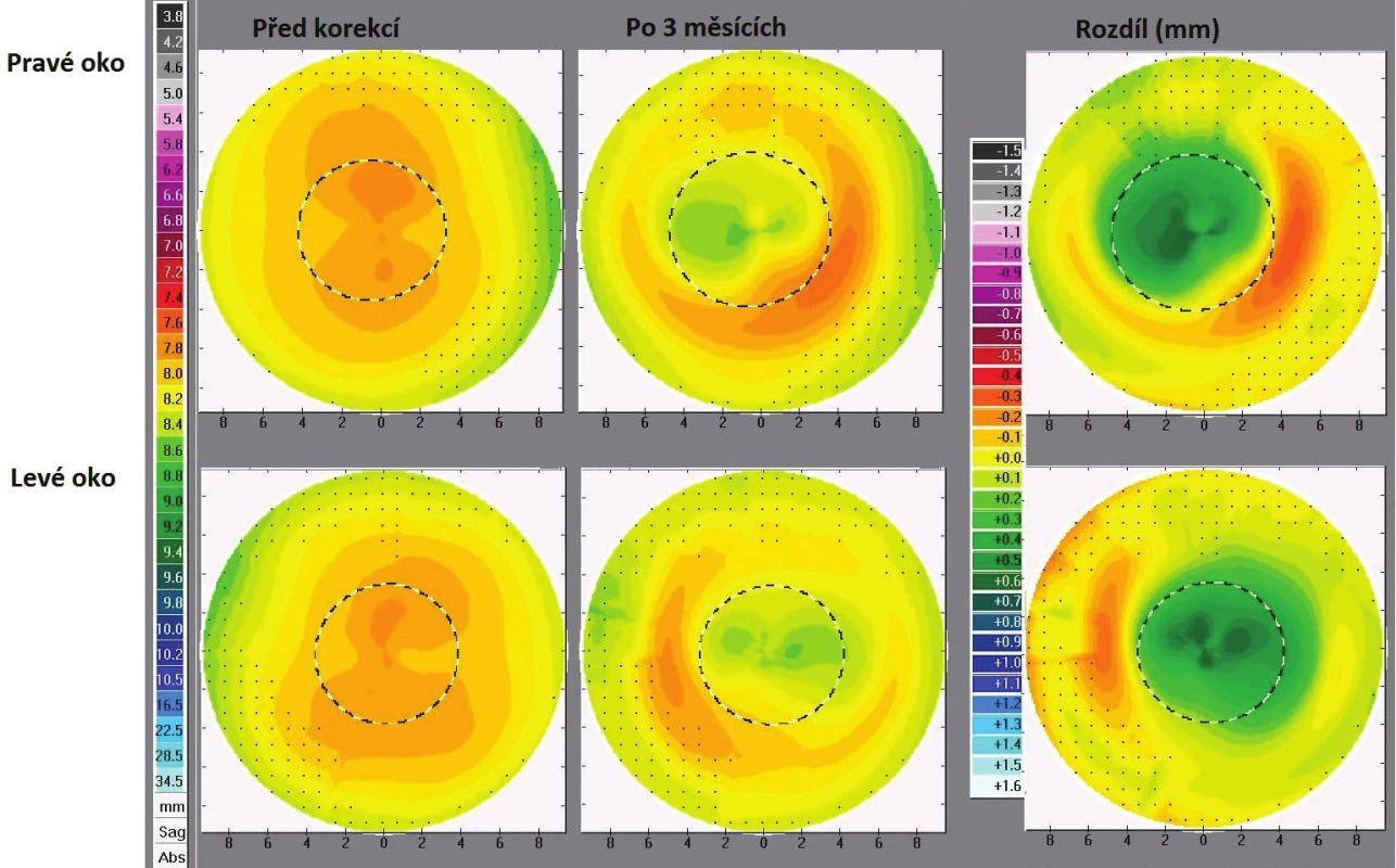 Sagitální mapy pravého a levého oka před zahájením korekce (vlevo), po třech měsících nošení ortokeratologických kontaktních čoček (uprostřed) a rozdílové mapy (vpravo)