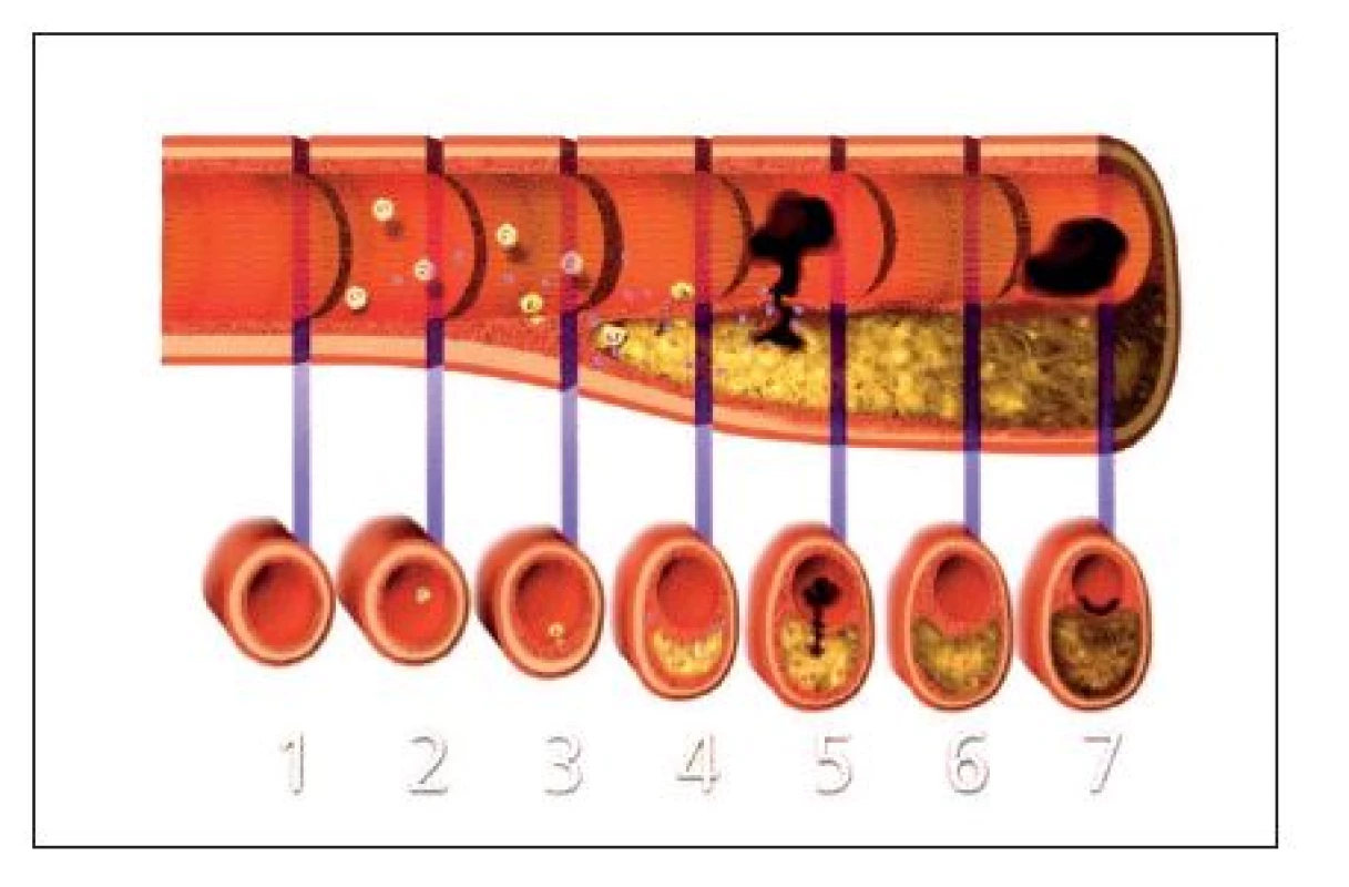 Vznik, vývoj a komplikace koronárního aterosklerotického plátu