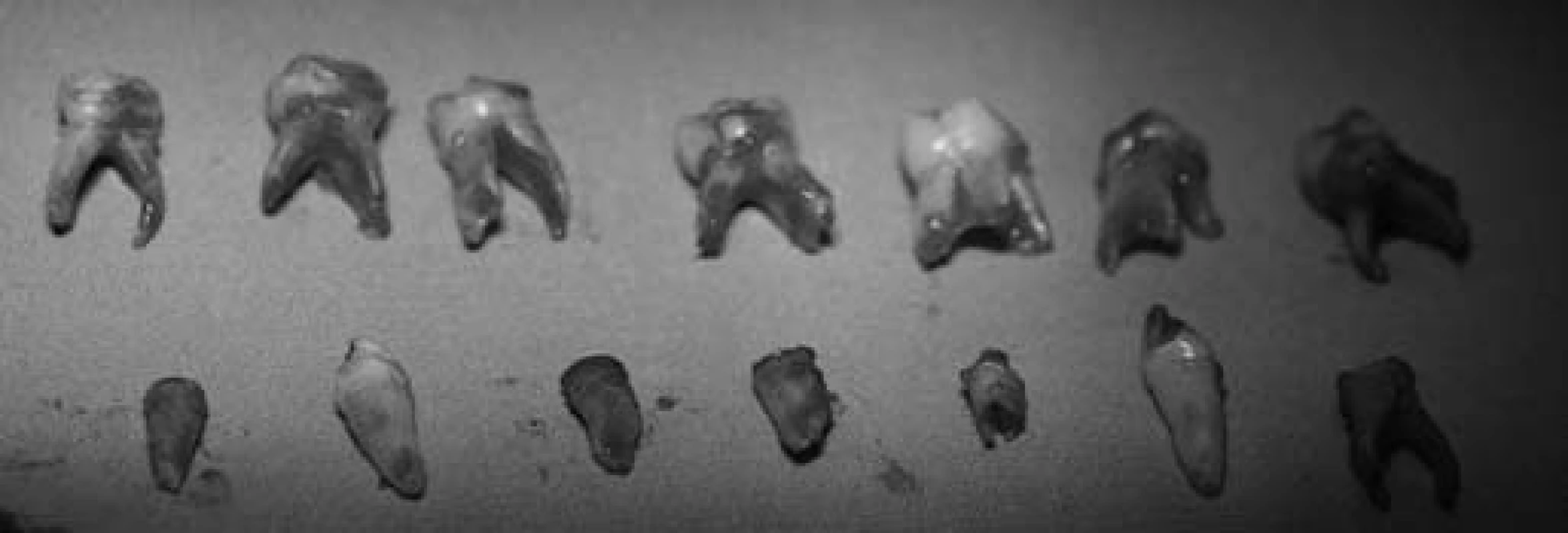 Stav po radikálním ošetření dočasného chrupu – extrahované zuby.
Fig. 5. Status after the radical treatment the temporary teeth – extract teeth