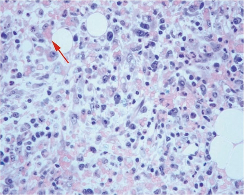 Bone Marrow Biopsy: activated macrophages engulfing erythrocytes suggesting HS