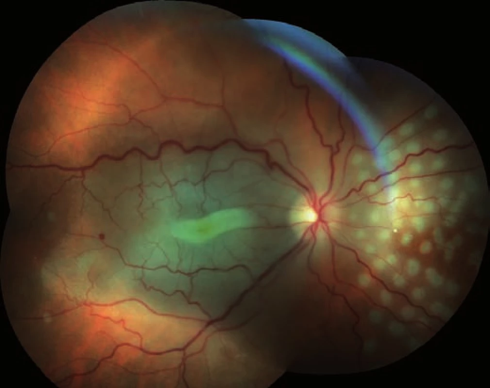 Sumovaný snímek tří barevných fotografií očního pozadí první pooperační den: retinální řečiště je průchodné, makula bledá s bílým pruhem ve foveole a zvýrazněním žlutého zabarvení neuroretiny. V nazálním kvadrantu je patrný žlutý embolus v arteriálním řečišti