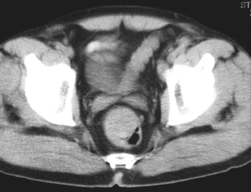 CT obraz objemného lymfomu v rektu
Fig. 2. CT scan of voluminous rectal lymphoma