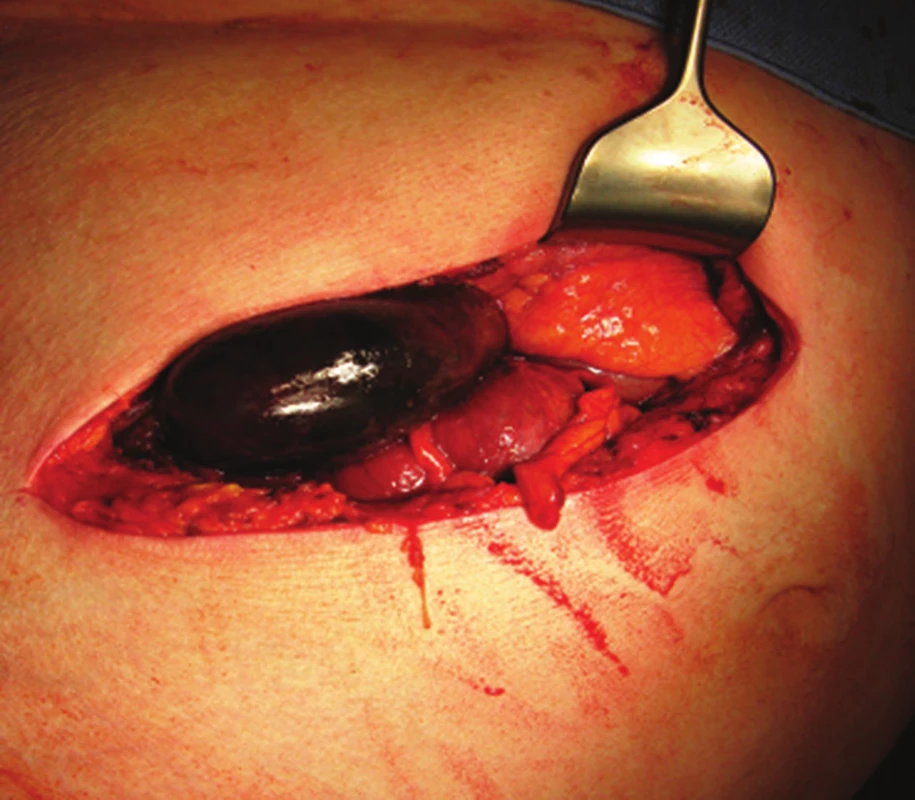 Gangrenózní žlučník po otevření dutiny břišní
Fig. 4: Gangrenous gallbladder after opening the abdominal cavity