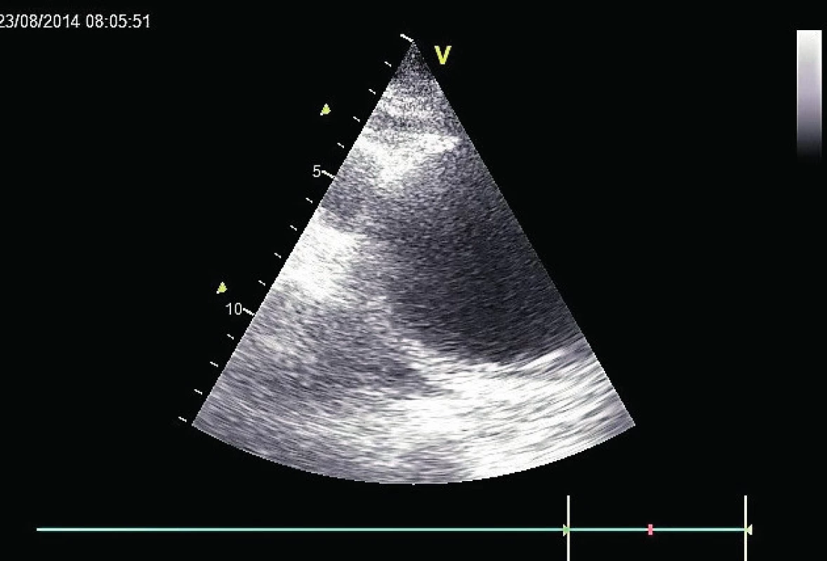 Výrazná dilatace aortálního oblouku
Aortální oblouk dilatovaný na 8 cm, zobrazený transjugulárně v TTE.
