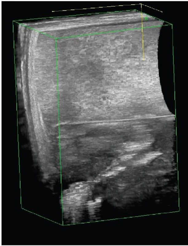 3D endosonografický obraz typické transsfinkterické píštěle
Fig. 1: 3D endosonography imaging of typical transsphincteric fistula