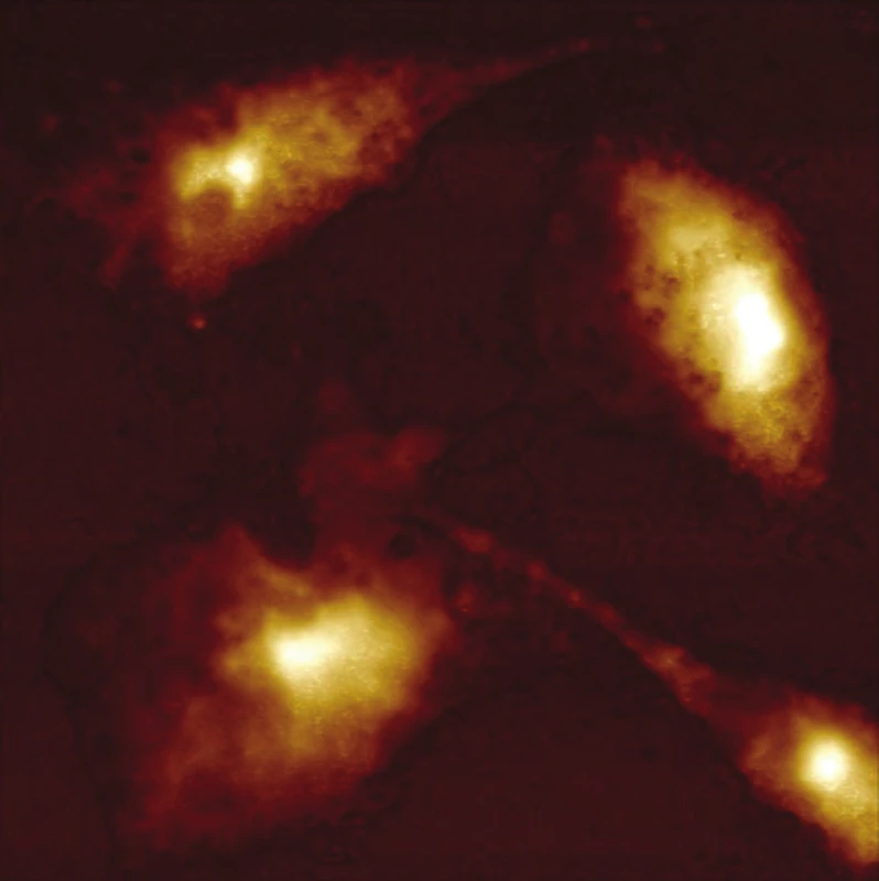 Buňka HeLa po fotodynamické terapii. Inkubace 6 h od ozaření (5 J.cm&lt;sup&gt;-2&lt;/sup&gt;) při 37 °C a 5% CO&lt;sub&gt;2&lt;/sub&gt;. Velikost skenu 53 × 53 μm. Výška neošetřené buňky – 4,2 μm, v ose x 25 μm, v ose y 21 μm. Světlá oblast udává největší výšku buněk. Skenováno v módu ScanAsyst bez chemické fixace. Skenovací rychlost 0,1 Hz.
