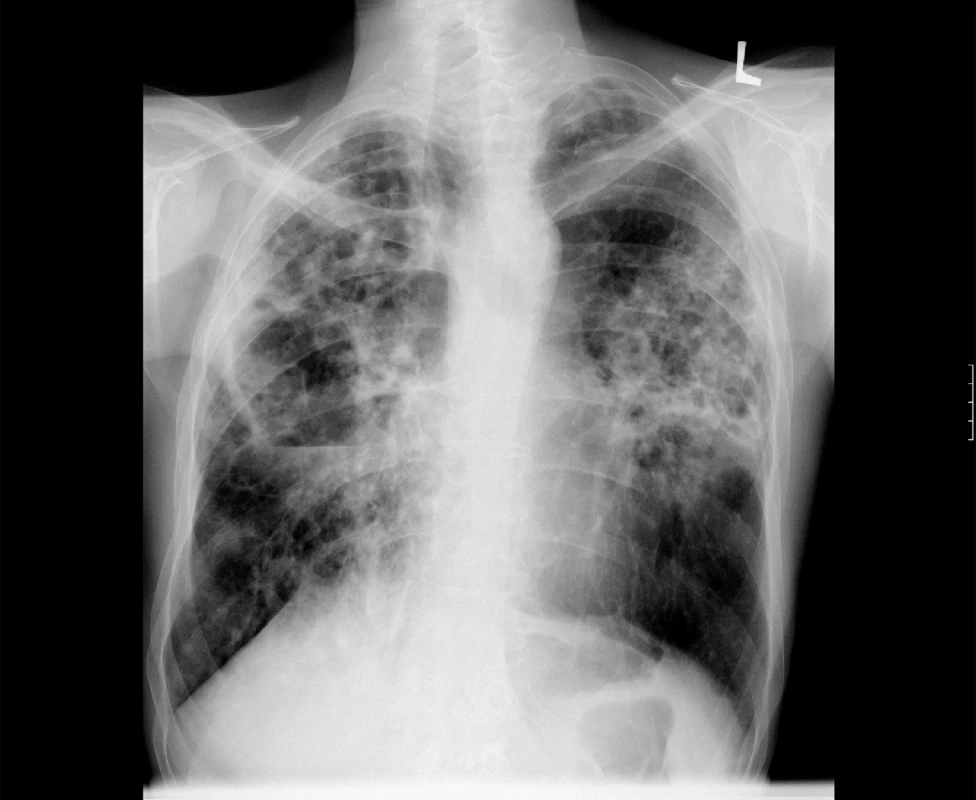 Zadopřední skiagram hrudníku. Rozsáhlé plicní postižení s kavitami u plicní mykobakteriózy – M. avium