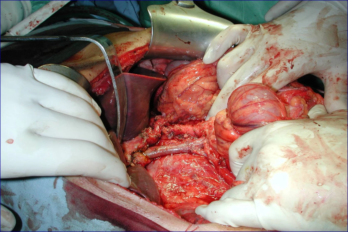 Stav po provedení žilní rekonstrukce u téhož pacienta (peroperační foto)