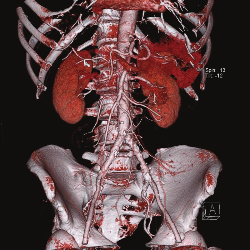 Angio-CT vyšetření: zobrazení mezenterického řečiště, VRT rekonstrukce