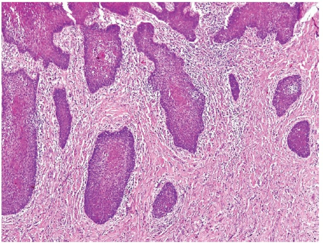 Median rhomboid glossitis. Squamous pseudoepitheliomatous hyperplasia simulating invasive well differentiated squamous cell carcinoma (magnification 100x).