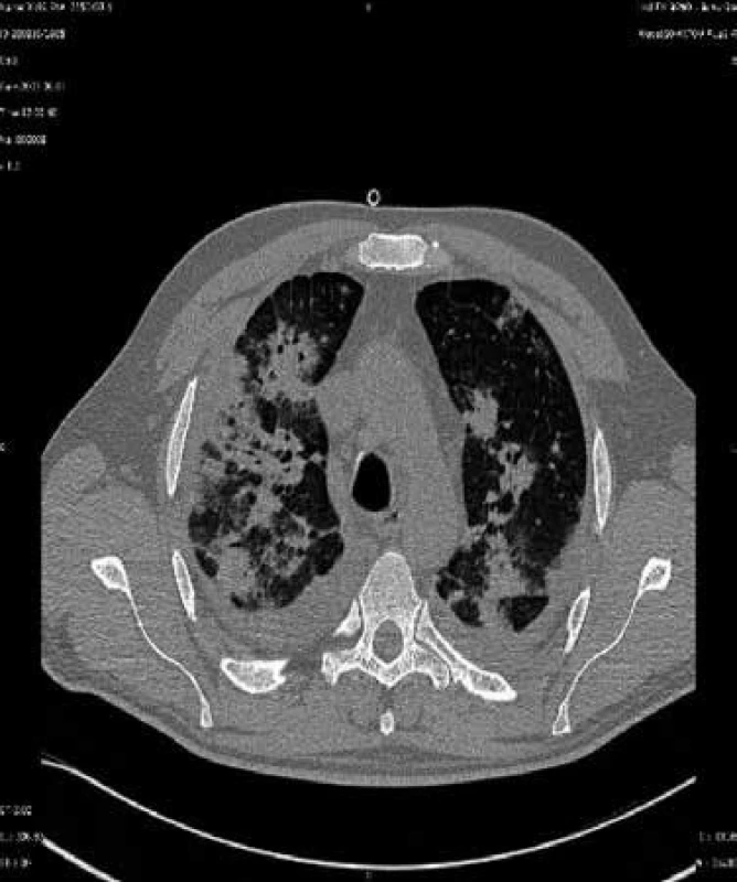 CT sken nemocného s aspergilovou pneumonií