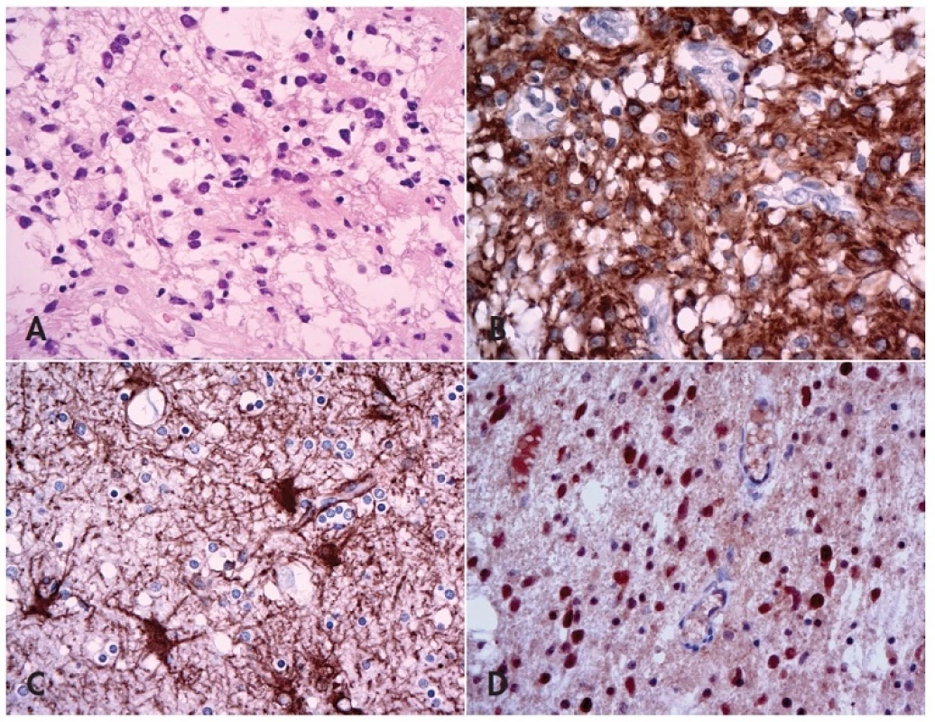 Fibrilární astrocytom versus glióza.