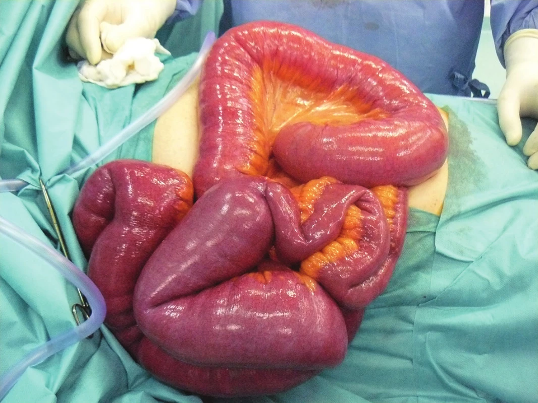 Ileus tenkého střeva na podkladě entero-enterální invaginace
Fig. 6: Ileus of the small intestine due to entero-enteral invagination