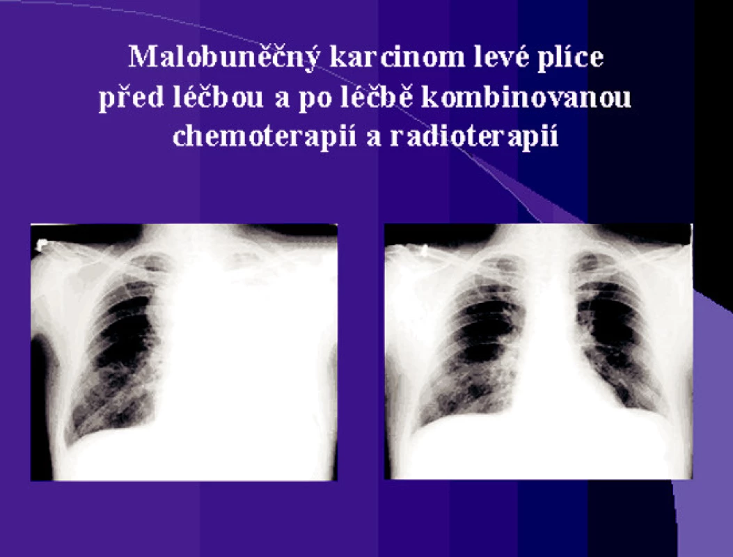 Malobuněčný karcinom levé plíce před léčbou a po léčbě
