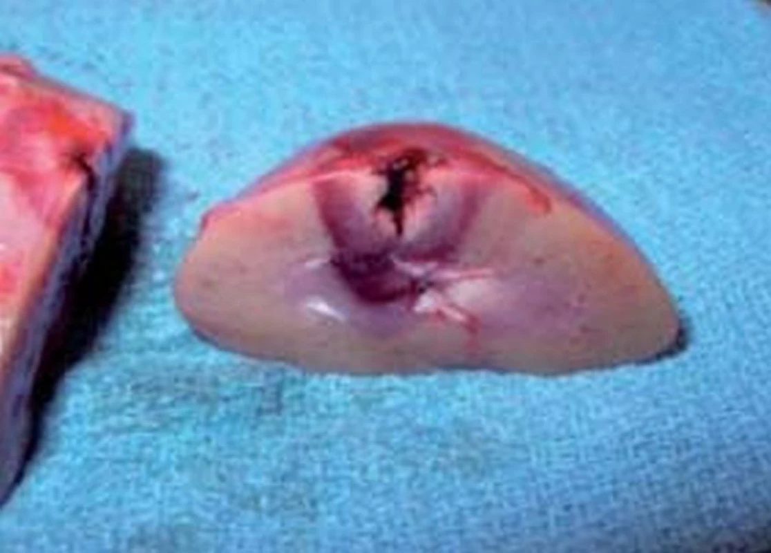 RFA destrukce nádorové tkáně ledviny.