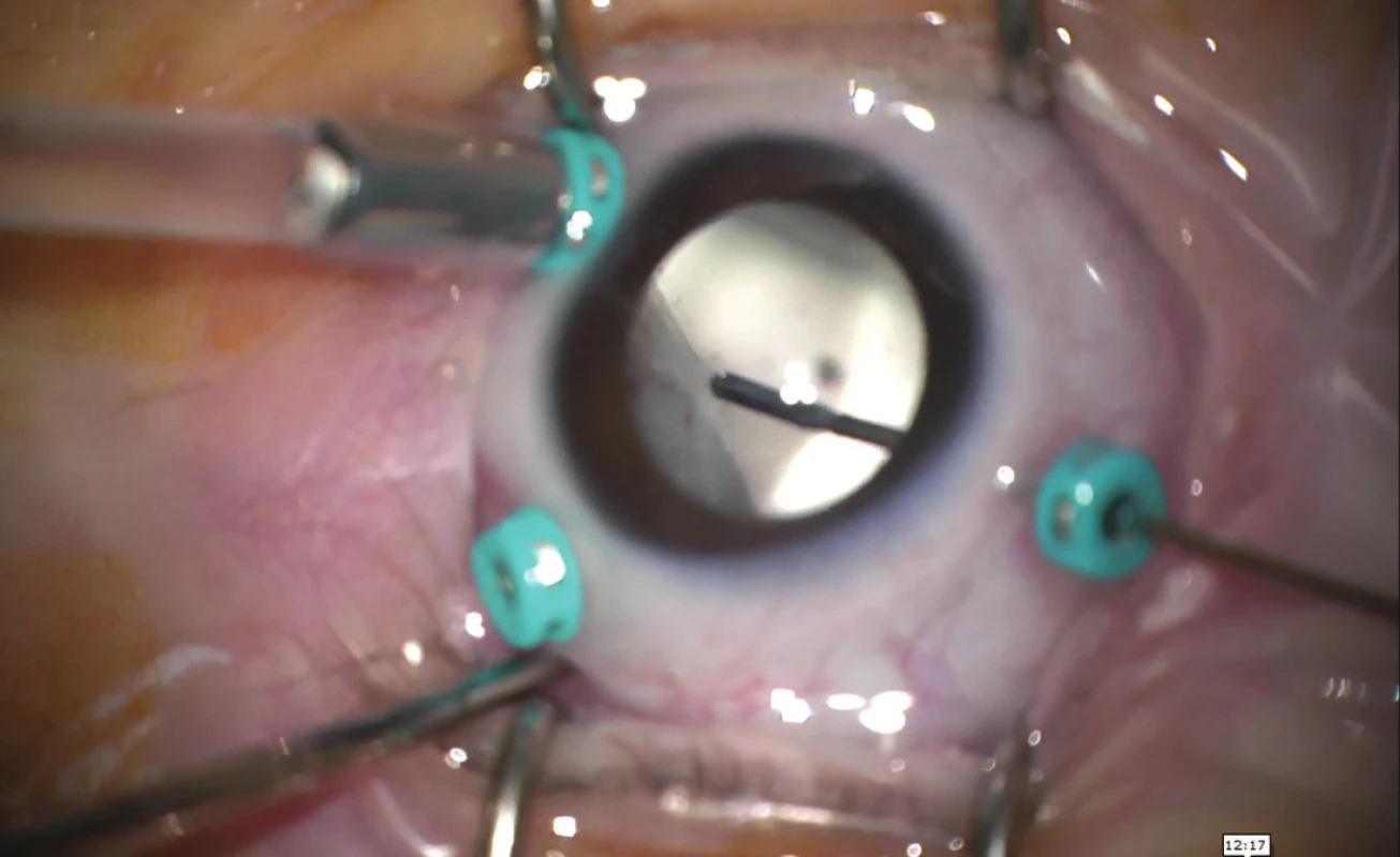 Peroperační nález OL: po provedení lensektomie, shave vazivových membrán na povrchu elevovaného trakčního hřebenu v periferii