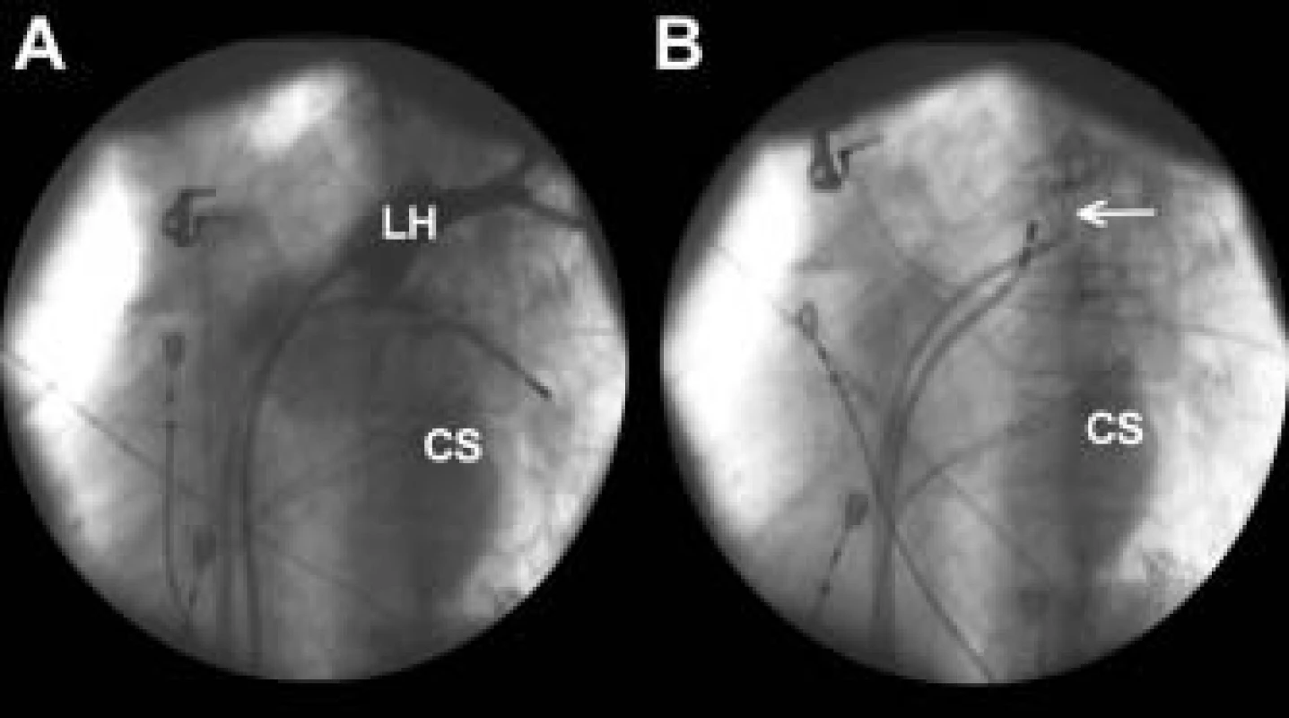 Angiografie plicní žíly a zavedení cirkulárního katétru do plicní žíly.
Na části A je zobrazena levá horní plicní žíla a její ústí do levé síně nástřikem kontrastní látky. Angiografické zobrazení plicní žíly zmrazené na 2. obrazovce skiaskopického přístroje umožňuje přímé hodnocení polohy cirkulárního katétru uvnitř žíly (šipka) (B) a místa aplikací radiofrekvenční energie ablačním katétrem v průběhu výkonu. Angiografické zobrazení plicní žíly poskytuje v průběhu samotného vyšetření neocenitelnou přímou korekci anatomických vztahů plicních žil a levé síně i při použití elektroanatomického mapování.