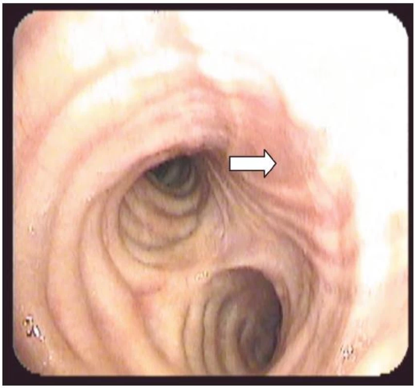Druhý případ. BSK měsíc od poranění, již patrná jizva (šipka) po zhojené ruptuře, není patrný defekt či prolaps membranozní části trachey