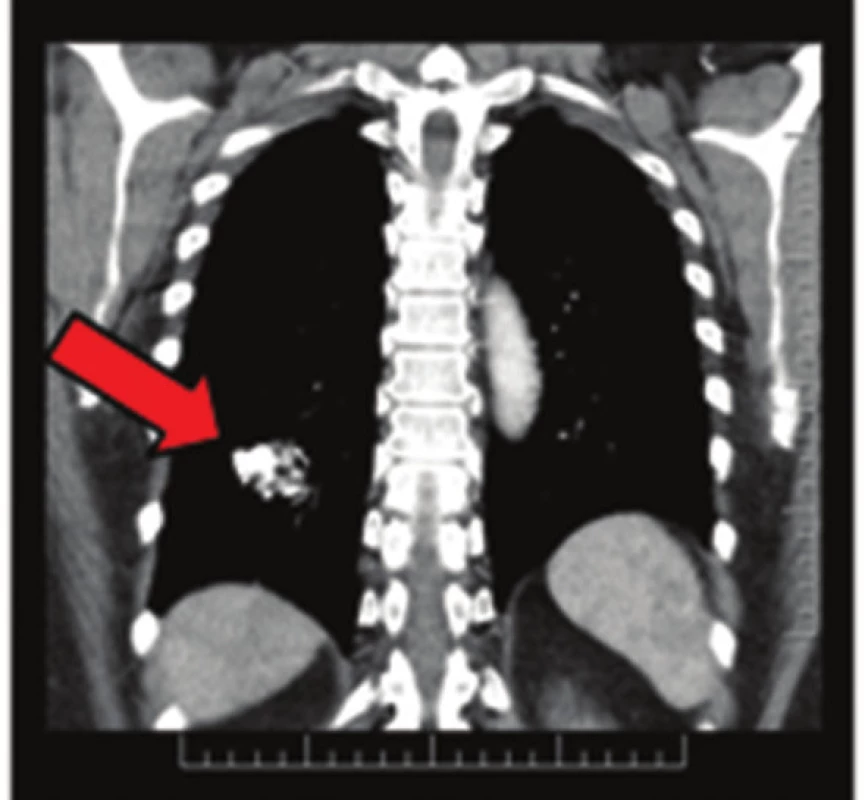 Plicní chondrom na CT snímku
Fig. 4: Pulmonary chondroma on CT scan