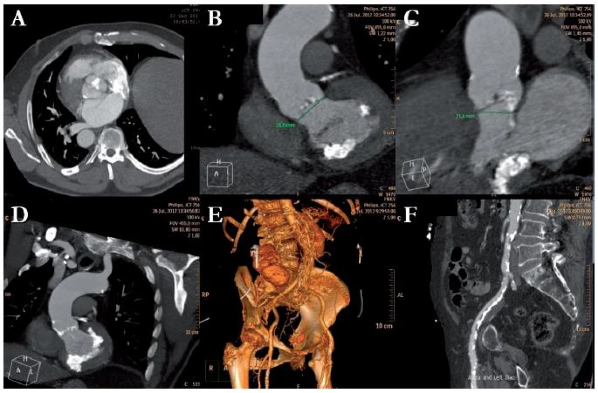 CT u pacientů před TAVI se používá k hodnocení morfologie aortální chlopně (A – bikuspidální kalcifikovaná aortální chlopeň), k měření aortálního prstence, důležitého pro správný výběr velikosti náhrady (B, C), k hodnocení vztahu prstence a odstupu koronárních arterií, hodnocení anatomie ascendentní aorty (D). Zobrazením periferních tepen při jednom vyšetření lze také vybrat optimální přístup pro výkon. Důležité je zejména posouzení tortuosity (E), měření minimální lumen a množství kalcifikací periferních tepen (F).