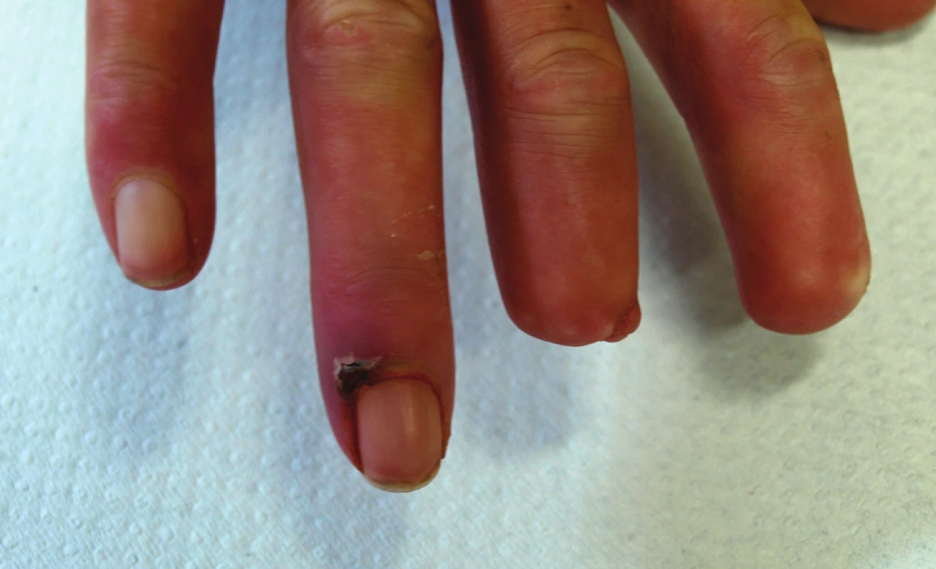 Stav v červenci 2010.
Kožní defekt na dorzální straně distálního článku 4. prstu pravé ruky.