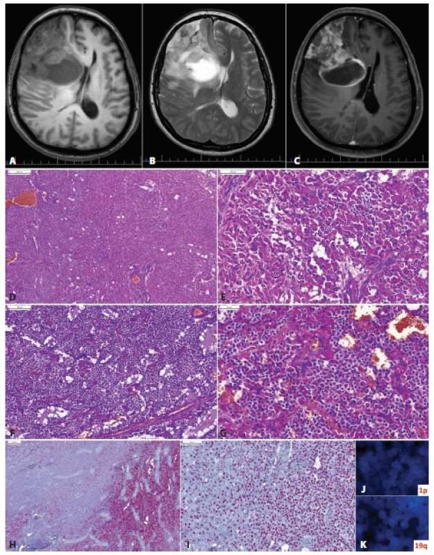 Glióm frontálneho laloka vpravo u 53-ročnej ženy s anamnézou mesiac trvajúcich bolestí hlavy. Na MRI izo- až hypodenzné cystické ložisko s perifokálnym edémom a prstencovitým „enhancementom“ (A, T1; B, T2; C, T1 s gadolíniom). Lézia mala mikroskopicky dve relatívne ostro oddelené zložky: oligodendrogliálnu (D, ľavá tretina obrázku) a astrocytárnu, s nápadnou gemistocytickou diferenciáciou (D vpravo, E). Oligodendrogliálna zložka mala vzhľad prototypického oligodendrogliómu (F), ložiskovo s početnými minigemistocytmi (G). Imunohistochemicky bol tumor IDH1-pozitívny v oligodendrogliálnej zložke (H, vpravo) a negatívny v astocytárnej časti (H, vľavo). Expresia ATRX bola zachovaná v oboch častiach (I). FISH vyšetrením bola v oligodendrogliálnej časti dokázaná kodelécia 1p/19q (J,K). Nádor bol klasifikovaný ako anaplastický oligodendroglióm, IDH-mutovaný, s kodeléciou 1p/19q, WHO grade III. Astrocytárna zložka je nenádorová/reaktívna. Podľa starej klasifikácie (WHO 2007) by takýto tumor mohlo byť klasifikovaný ako anaplastický oligoastrocytóm (zmiešaný glióm). Použitím genetickej analýzy (alebo zástupných imunohistochemických markerov – p53, IDH1, ATRX) je možné rozdelenie drvivej väčšiny „oligoastrocytómov“ na oligodendrogliómy a astrocytómy.