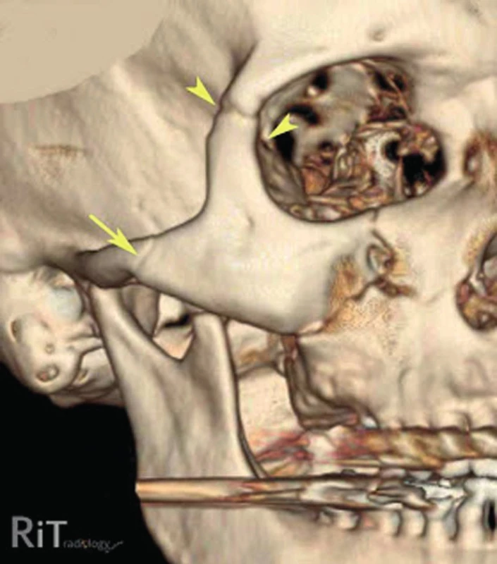 3D CT obraz zlomeniny lícně-čelistního komplexu