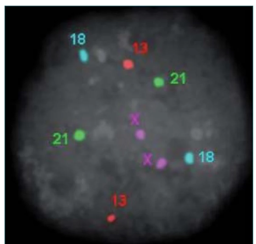 Výsledek fluorescenční in situ hydridizace jedné buňky embrya s označenými chromozomy X, Y, 13, 18, 21. Jedná se o embryo ženského pohlaví se správným počtem označených chromozomů.