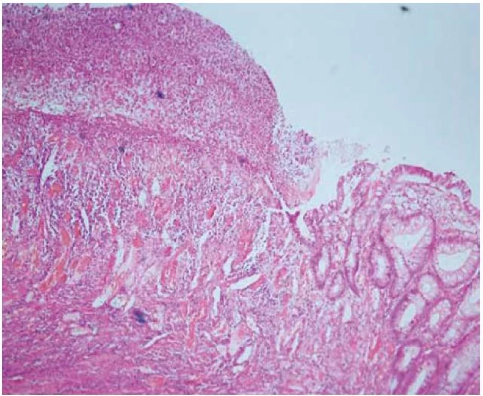 Histologický obraz ulcerácie, colon ascendens, hematoxylín eozín.
Fig. 3. Histologic specimen of ulceration in colon ascendens, haematoxylin eosin.
