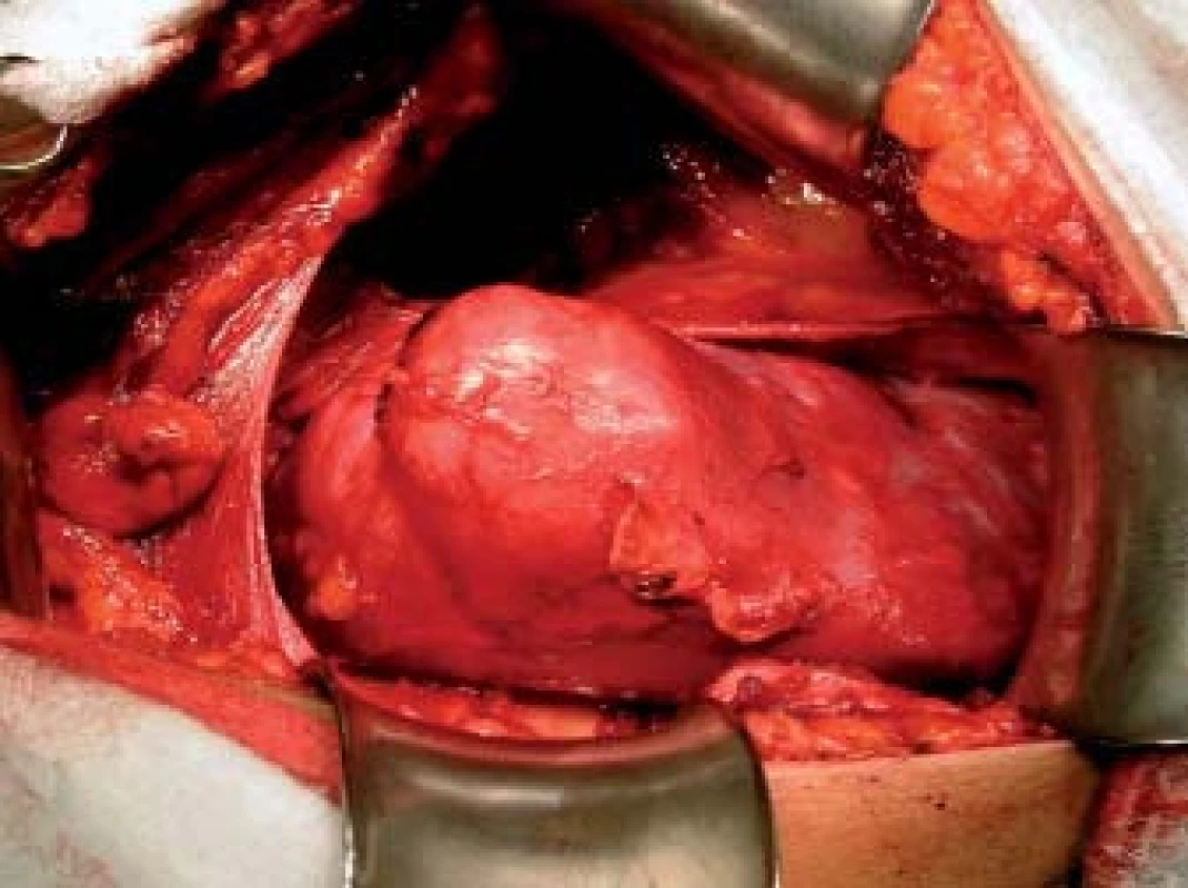 Tumor v oblasti středního segmentu ledviny.