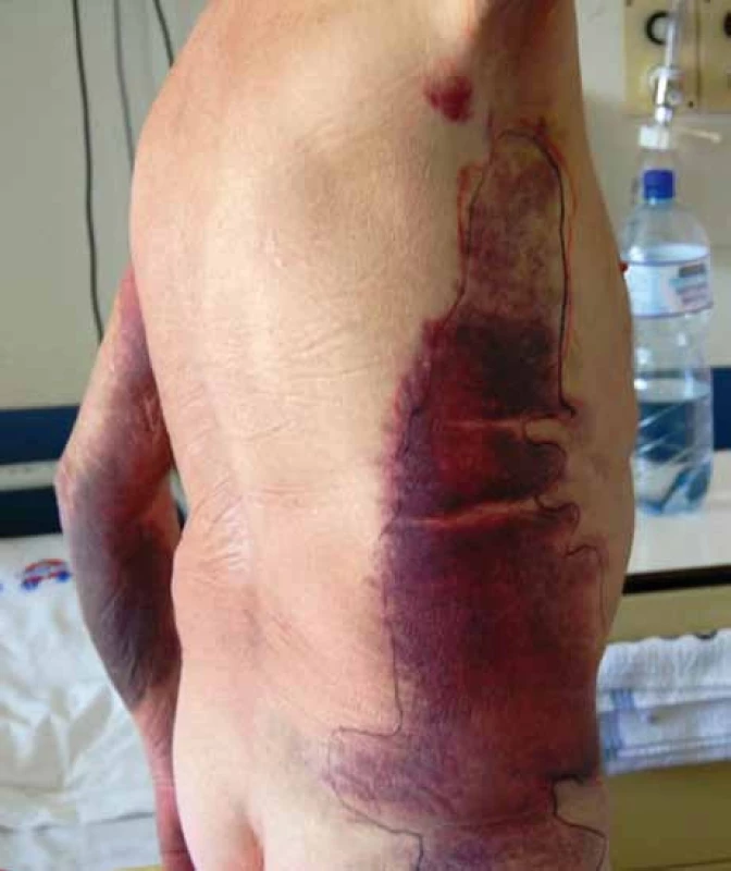 Rozsáhlé podkožní krvácení u pacienta se získanou hemofilií A.