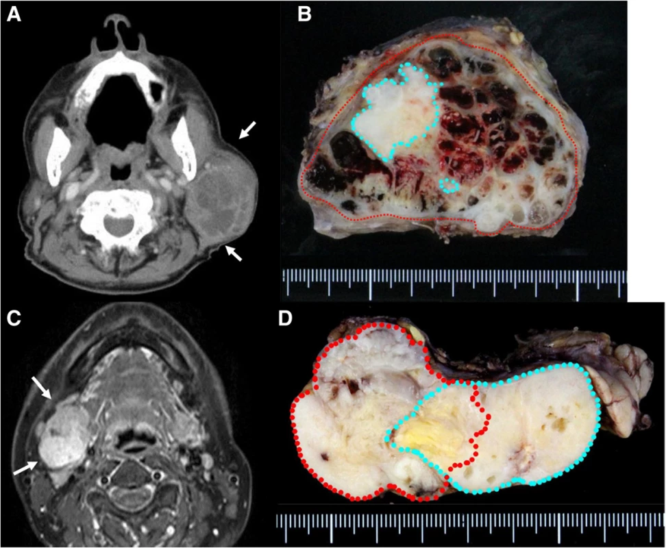 Enhanced CT revealed a large left neck mass with partial enhancement. Necrosis of the inner tumor was suspected. a Macroview of the tumor: PA was completely surrounded by MEC. Red line, cancer; blue line. PA, b MRI revealed a mass with bumpy surface in the right submandibular gland with a partially unclear border. c Macroview of the tumor: MEC existed outside of PA. Red line, cancer; blue line, PA