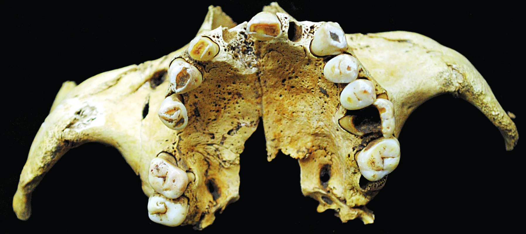 Klecany – muž, 35–50 let. Maxila – intravitální ztráta pravé M1, šikmé postavení pravého P1, hypodoncie P2, velký zubní kaz na levé M1