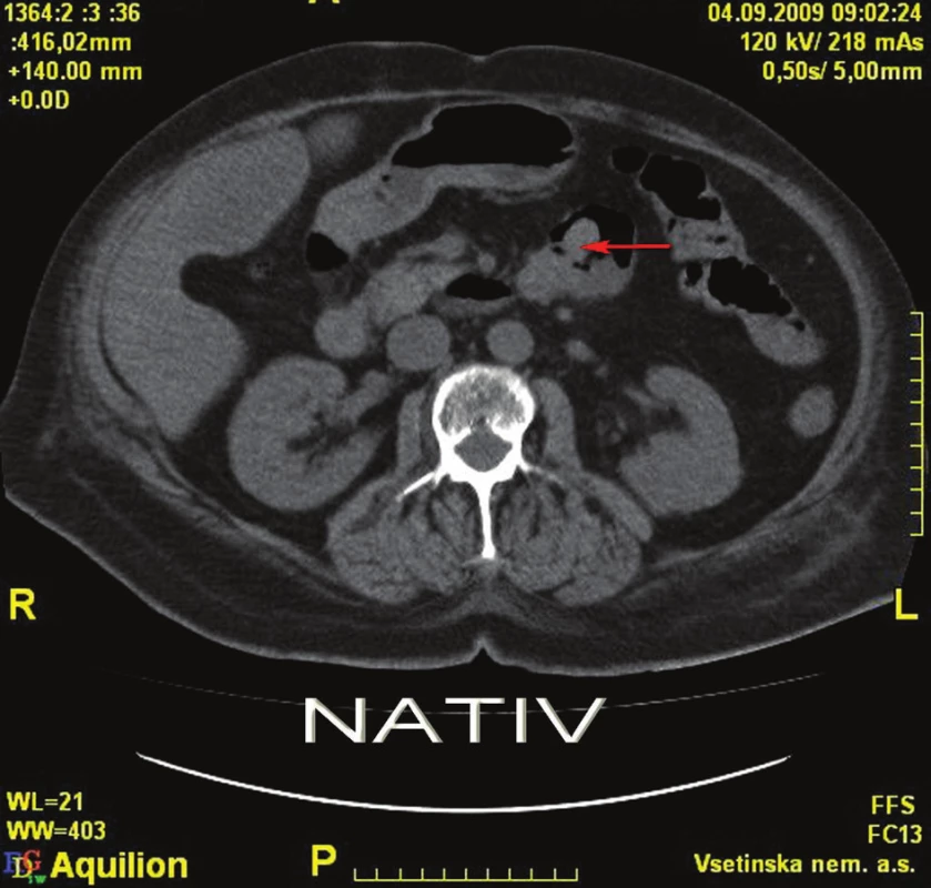 CT nativ – tumorózní léze duodena
Fig. 2: Plain CT – tumorous lesions of the duodenum