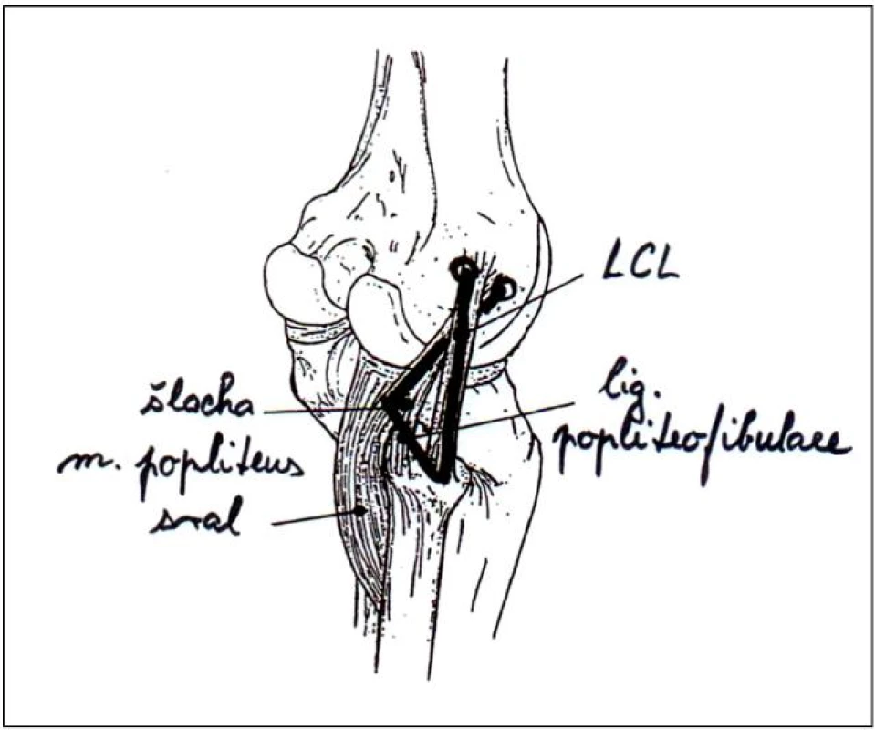 Znázornění anatomické rekonstrukce posterolaterálního rohu kolena
