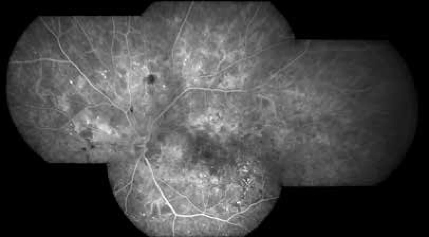 Fluorescenční angiografie neproliferativní diabetické retinopatie