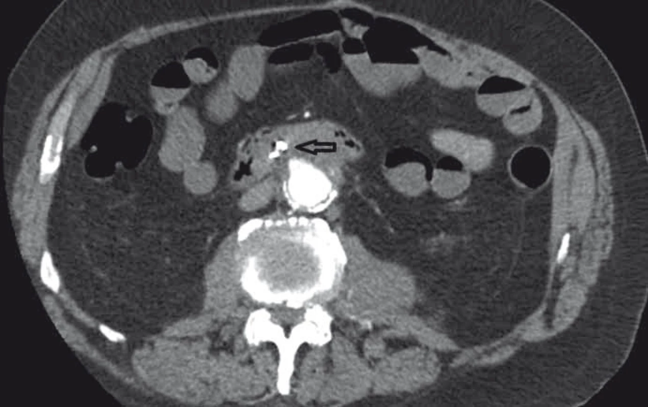 CT angiografie, transverzální zobrazení, arteriální fáze (šipka ukazuje píštěl).
Fig. 3. CT angiography, transversal view, arterial phase (the arrow points to the fistula).