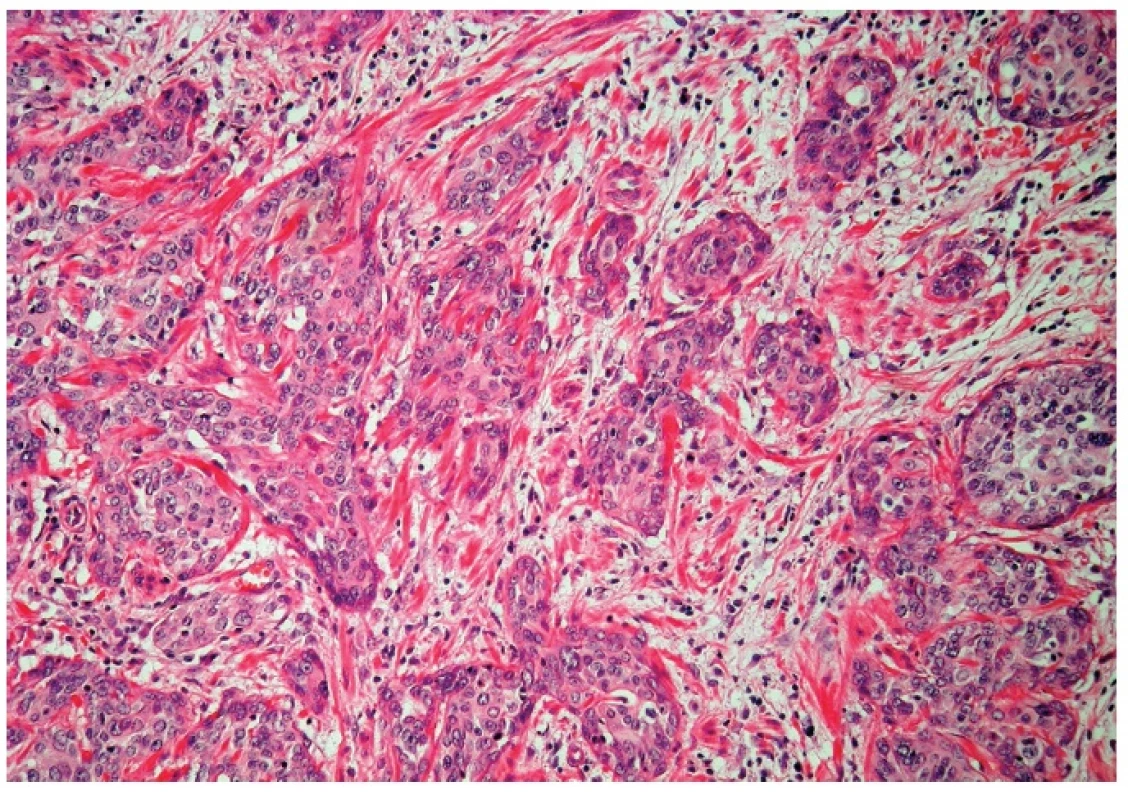 Invasive squamous cell carcinoma (H&amp;E, original magnification 200x).