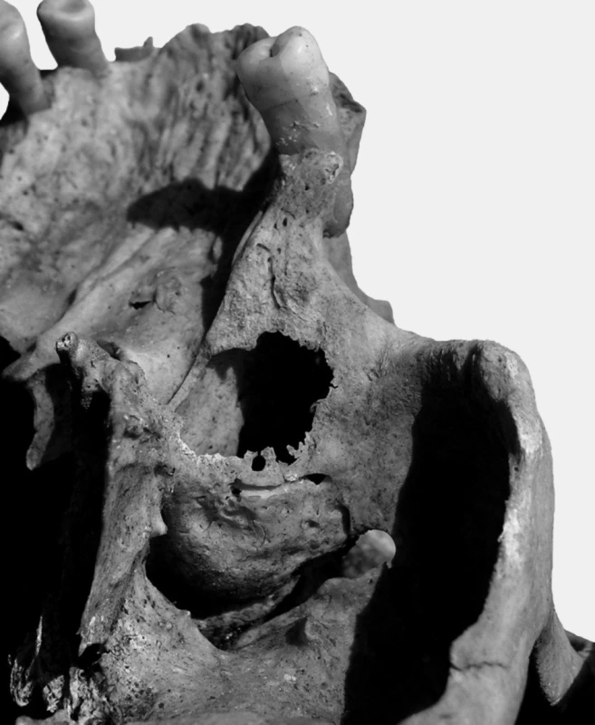 Na levé horní čelisti asi 50–60letého muže (hrob č. A 810) byly nalezeny v oblasti kořenů třetí stoličky stopy po chronickém zánětlivém procesu, který perforoval sinus maxillaris.