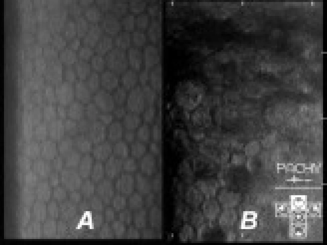 Zobrazení pravidelných hexagonálních buněk endotelu rohovky zrcadlovým mikroskopem u zdravého jedince (A); u postiženého vinaře je počet buněk snížen, jsou polymorfní a místy endotel zcela chybí (B).