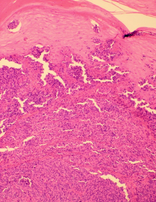 Histopatologický nález akrolentiginózního melanomu.