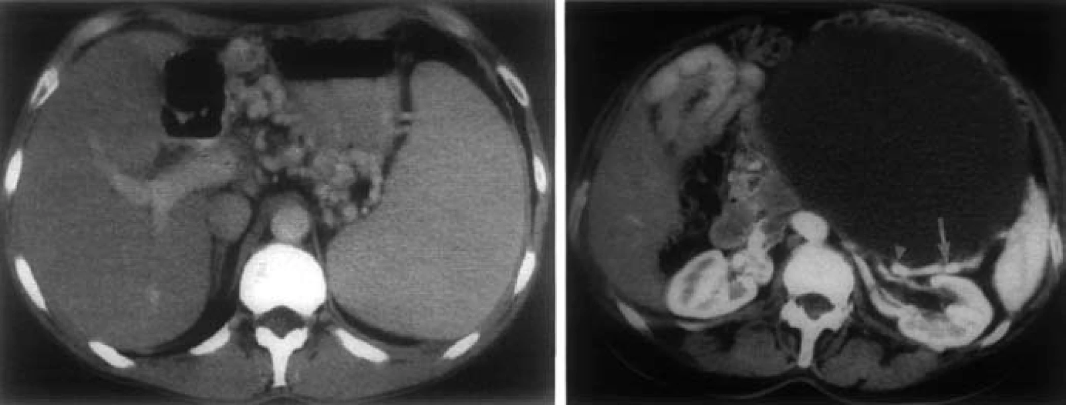 CT nález pri SPH. A – splenomegália, masívne gastrické varixy, B – pankreatický cystadenom. Lienálna véna (šípka) je uložená tesne za zadnou stenou TU a javí sa prerušená (trojuholník) [8].
Fig. 7. CT findings in SPH. A – splenomegaly, massive gastric varices, B – pancreatic cystadenoma. Splenic vein (arrow) is placed just behind the posterior wall of the tumor and appears broken (triangle) [8].