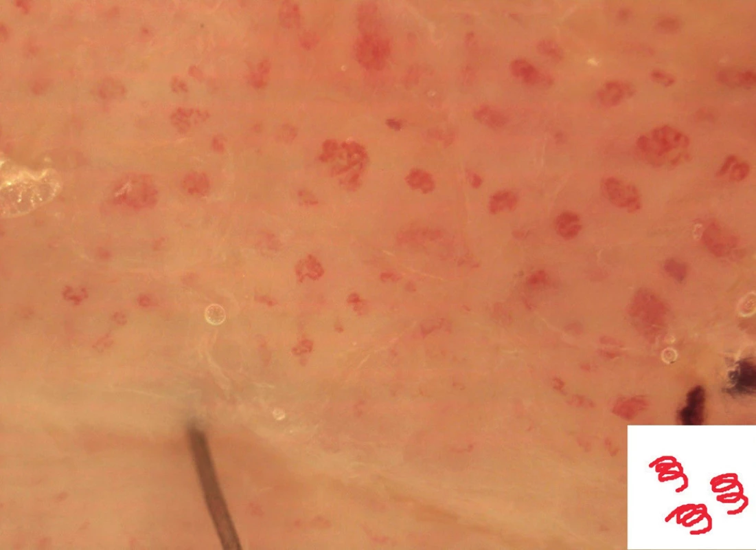 Glomerulární cévy (morbus Bowen)