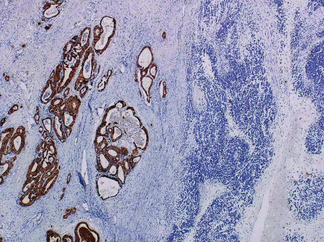Cytokeratin AE1/AE3 positivity in well-differentiated endometrioid carcinoma and negativity in an undifferentiated component (original magnification 40x)