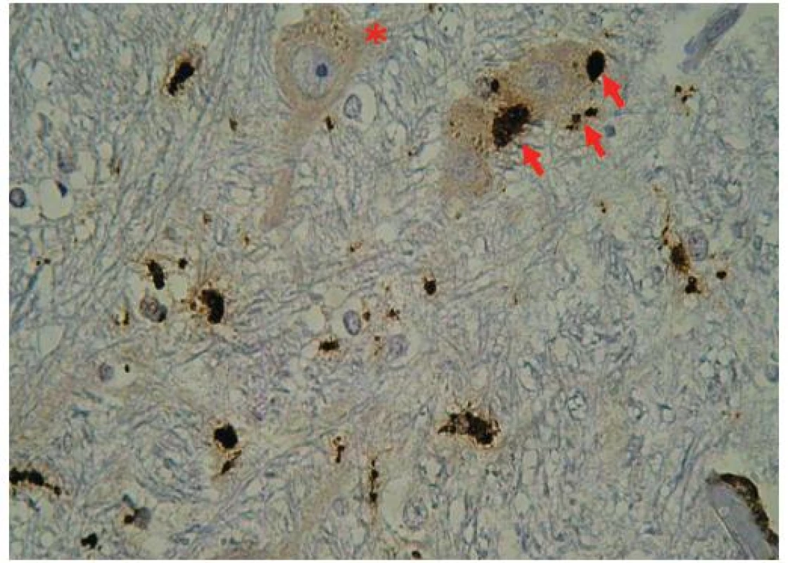 CD68 imunopozitivita v mozkovém kmeni. CD68 pozitivní mikroglie je v blízkosti gangliových buněk ( neuronofagie buňkami mikroglie je označena šipkou, neuron je označen hvězdičkou). Zvětšení 400x.