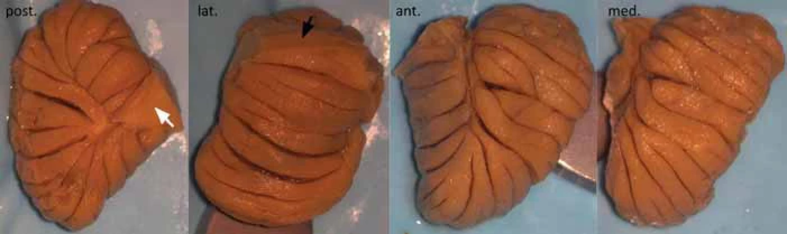 Detailní pohled na jednotlivé povrchy tonsilly cerebelli.