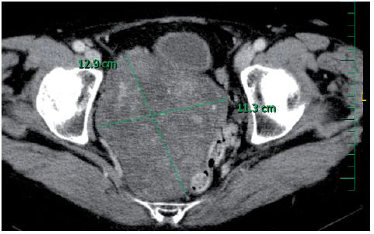 vyšetření pacientky před operační revizí – retroperitoneální schwannom s útlakem okolních orgánů (Somatom Emotion 16 (2007), Xenetix 350 (100 ml i.v.)) 
Fig. 2. CT scan of the patient before the surgical revision – a retroperitoneal schwannoma with a compression of organs (Somatom Emotion 16 (2007), Xenetix 350 (100 ml i.v.))